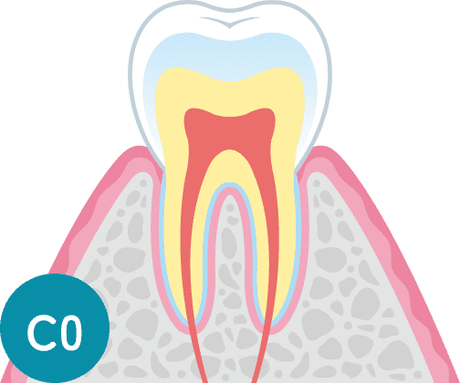 C0：初期虫歯の断面図