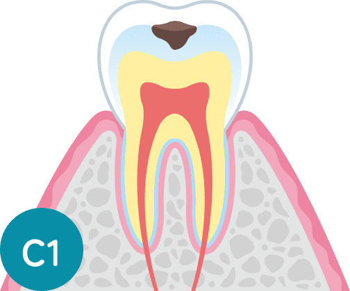 C1：エナメル質の虫歯の断面図