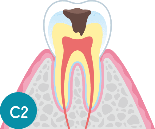 C2：象牙質の虫歯の断面図