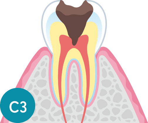 C3：神経に達した虫歯の断面図