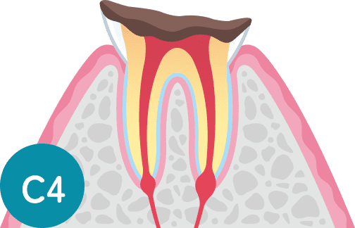 C4：歯根に達した虫歯の断面図
