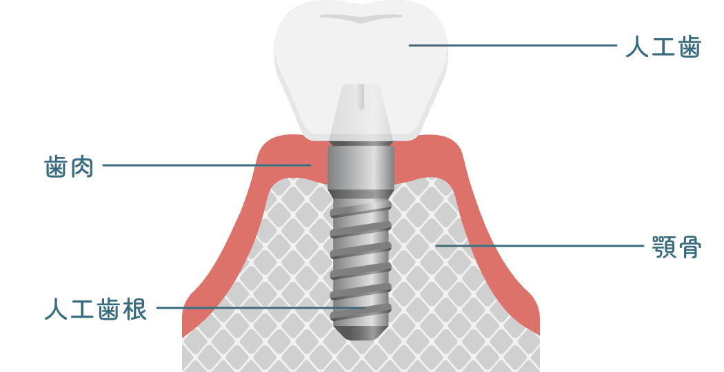インプラントの断面図