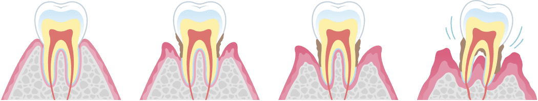 歯周病の進行の様子