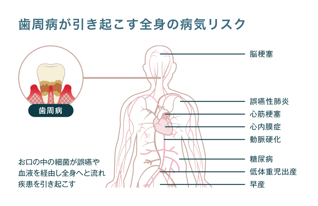 歯周病が引き起こす全身の病気リスク