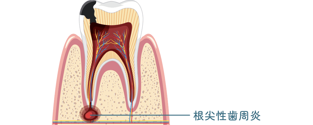 根尖性歯周炎の断面図