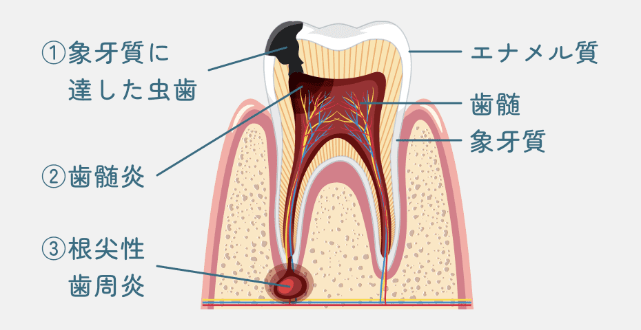 急な歯の痛みの原因