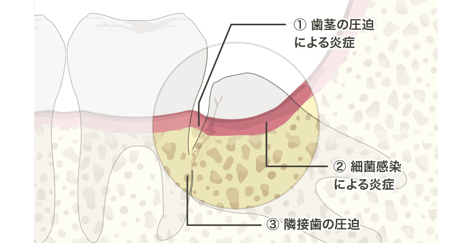 図：親知らずが痛む理由